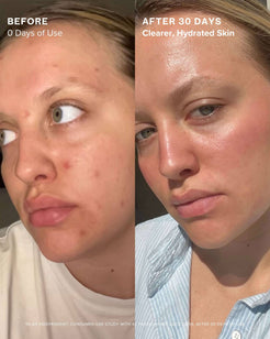 Clear Skin Mineral Milk 2% Salicylic Acid Acne Treatment with Niacinamide + Copper