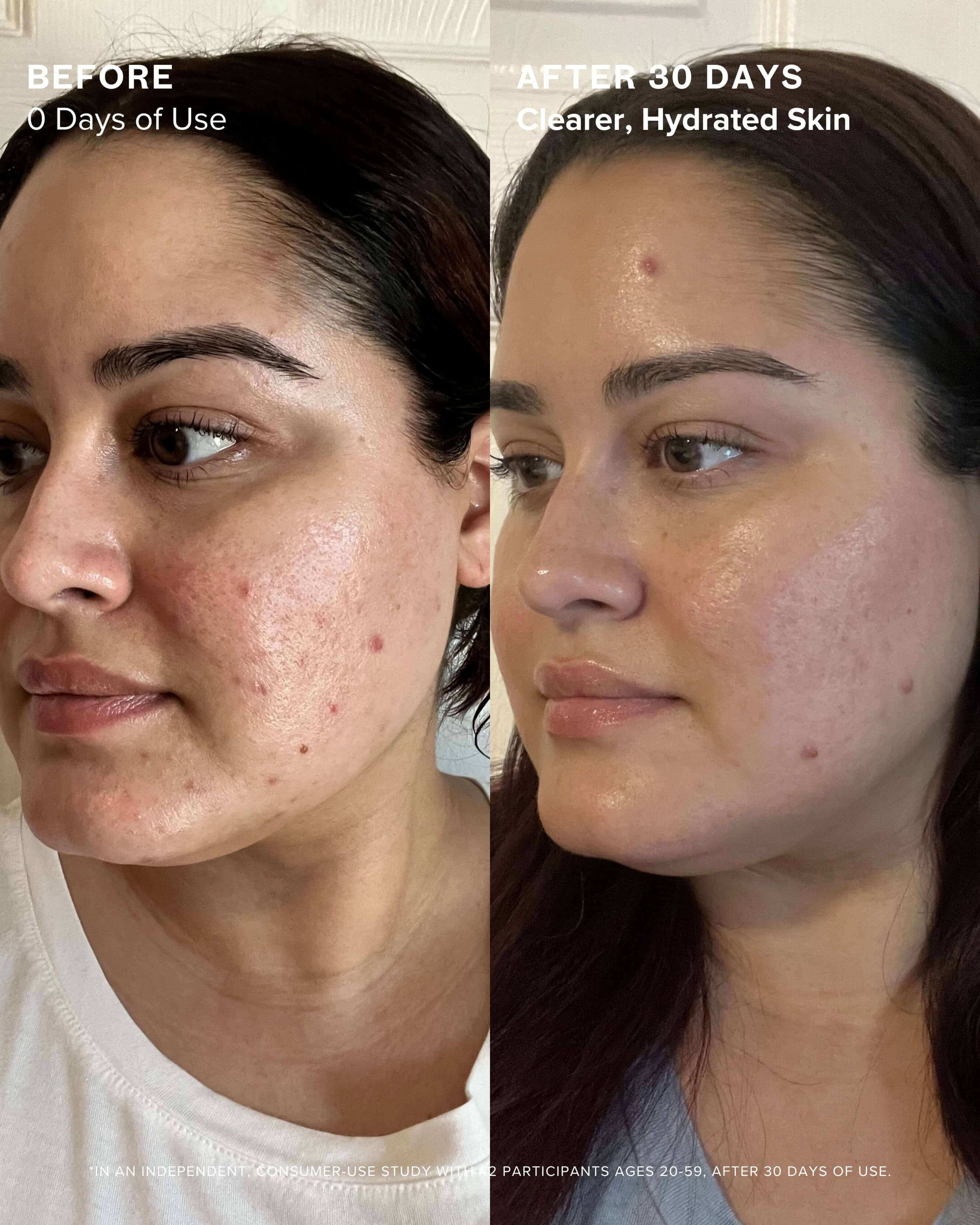 Clear Skin Mineral Milk 2% Salicylic Acid Acne Treatment with Niacinamide + Copper