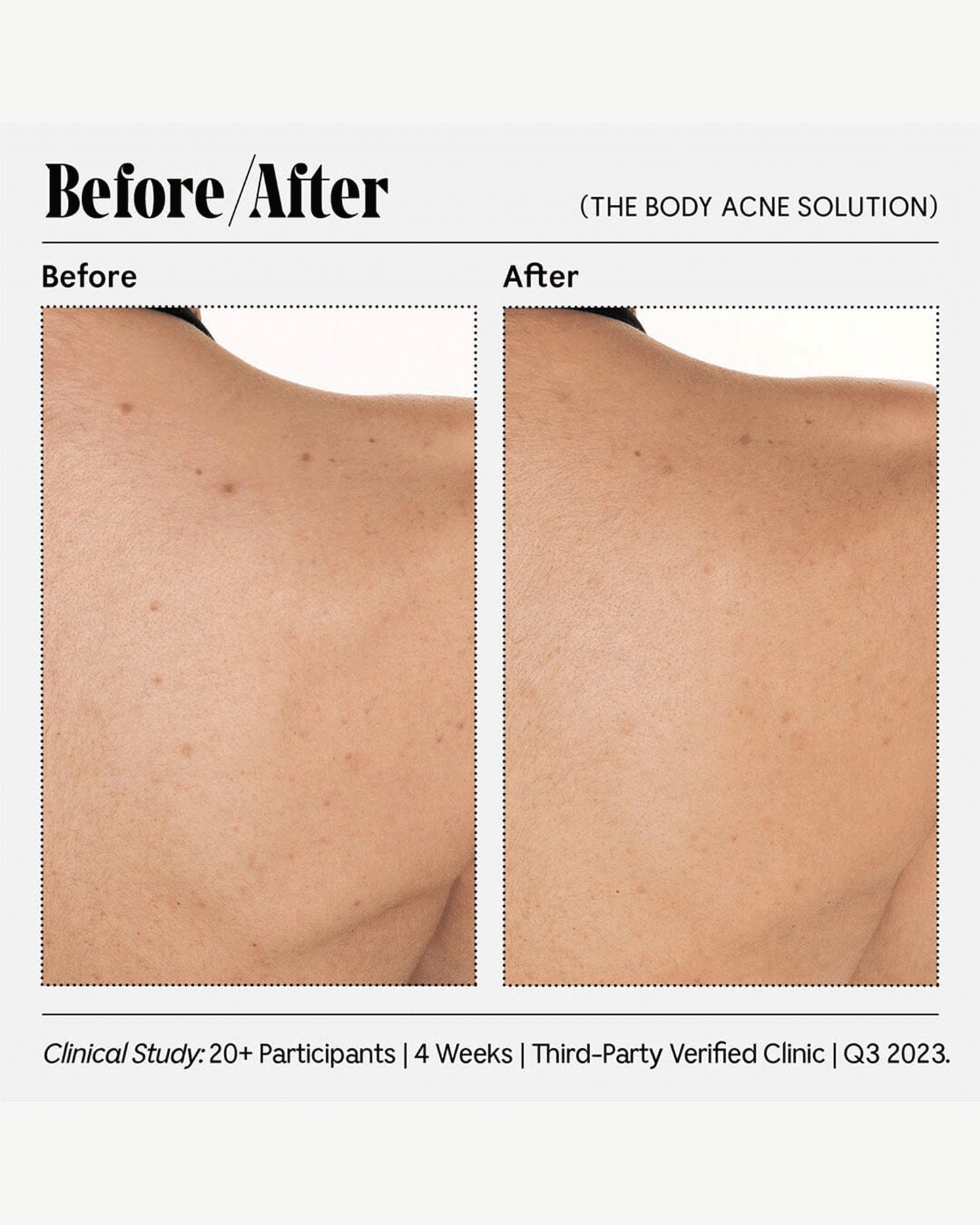 The Body Acne Solution