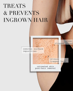 The Ingrown Bar