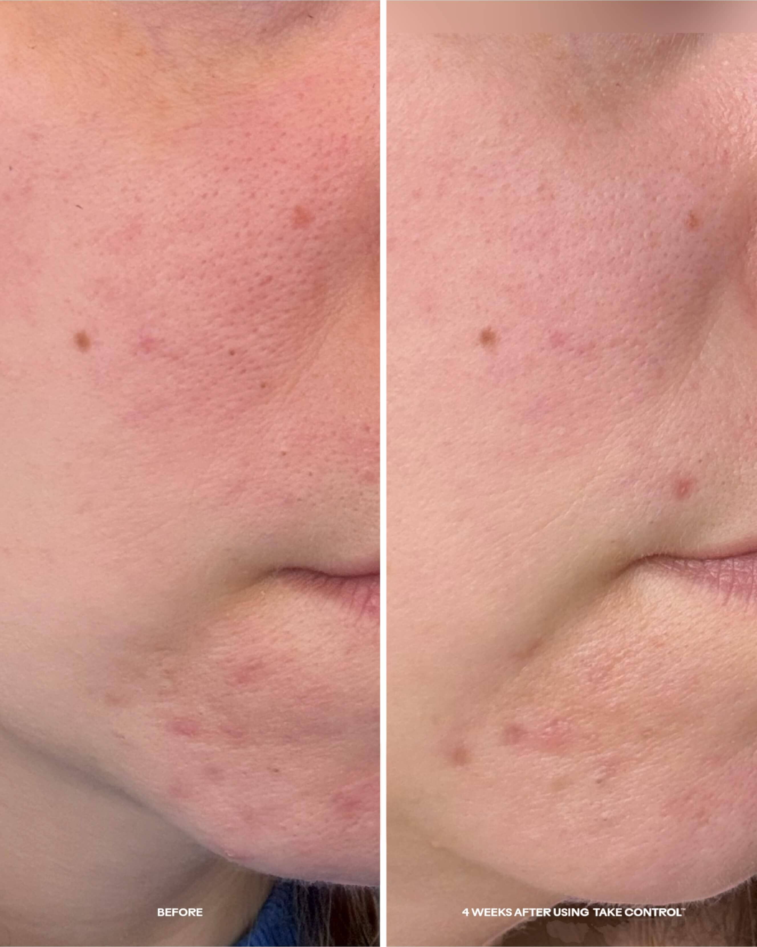 Take Control Salicylic + 10% Azelaic Acid Clarifying Serum