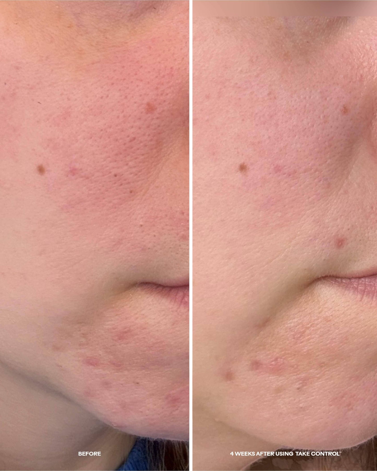 Take Control Salicylic + 10% Azelaic Acid Clarifying Serum